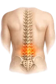 Low Back Pain