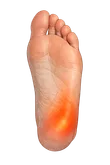 Plantar Fasciitis