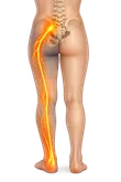 Sciatica