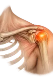 Shoulder Pain